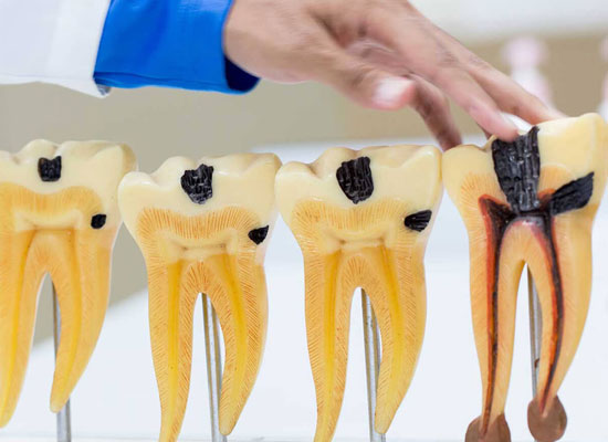 Root Canal Therapy