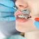 braces