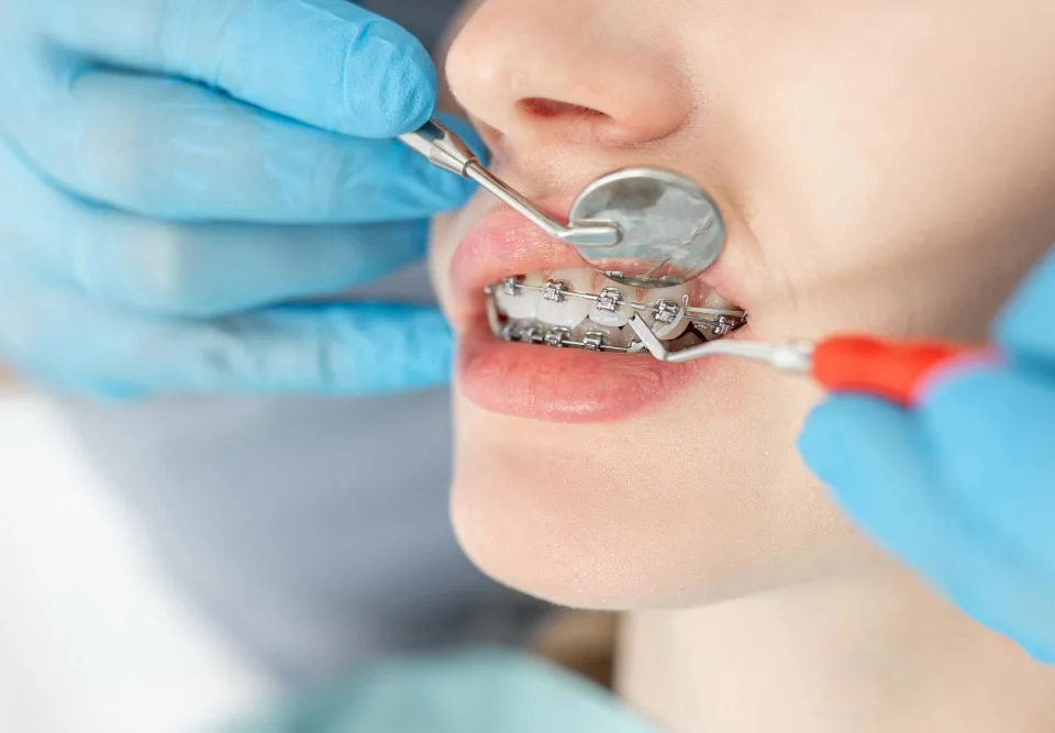 braces