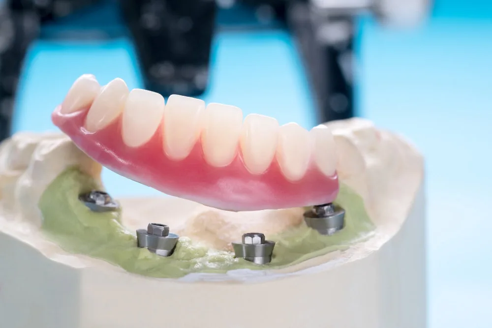 All on 4 Dental Implants img 1