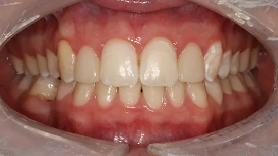 PATIENT AW after