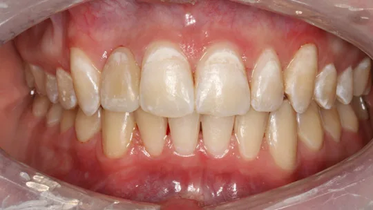 Patient CW after