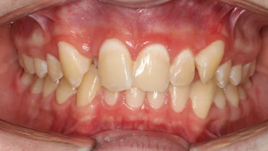 Patient CW before
