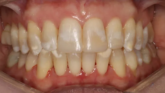 Patient DL after