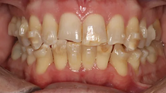 Patient DL before new
