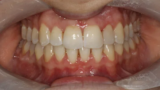 Patient EHP after
