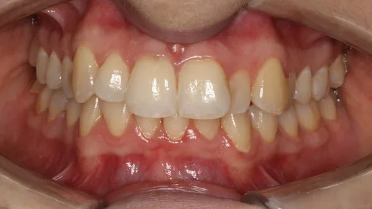 Patient EHP before