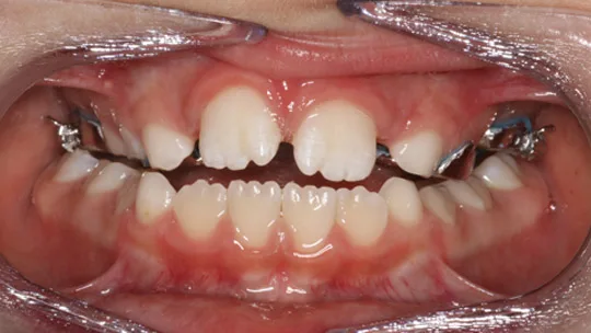 Patient IC Before