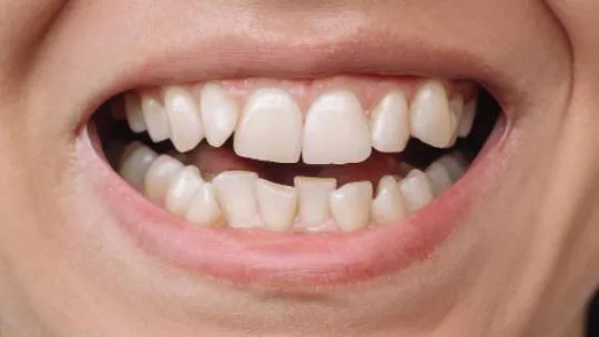 denture implant before