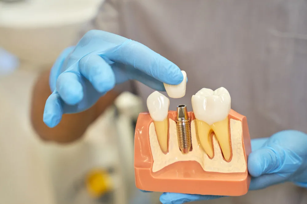 implant img 02