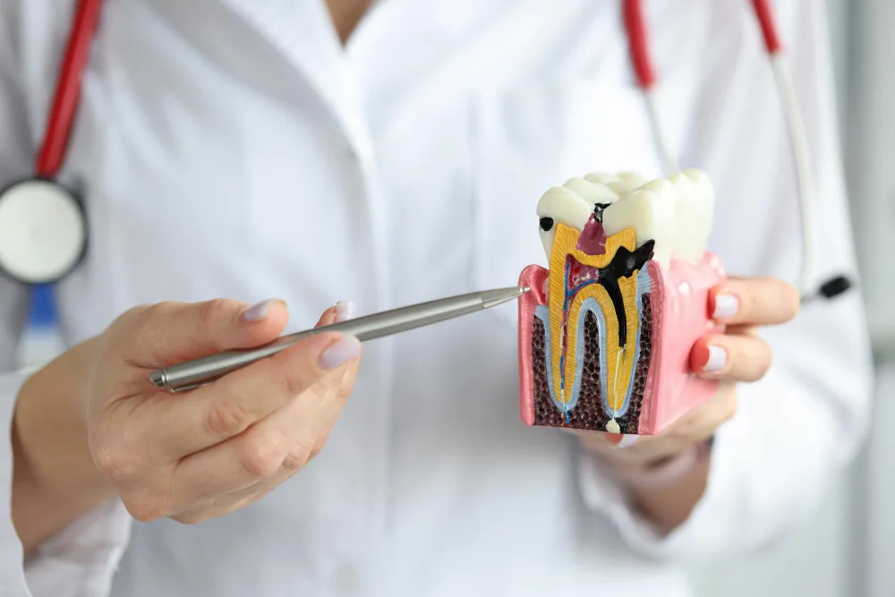 root canal img 2