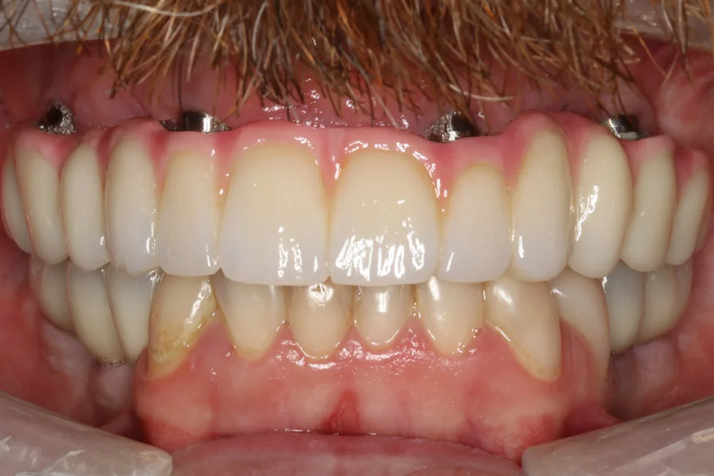All on 4 MM after
