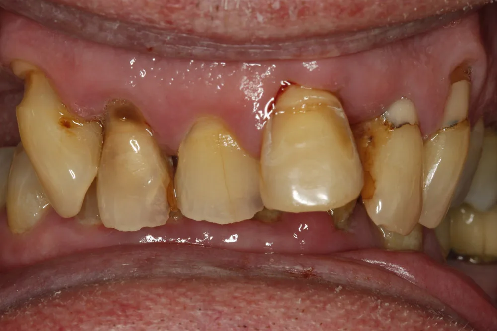 All on 4 pf before