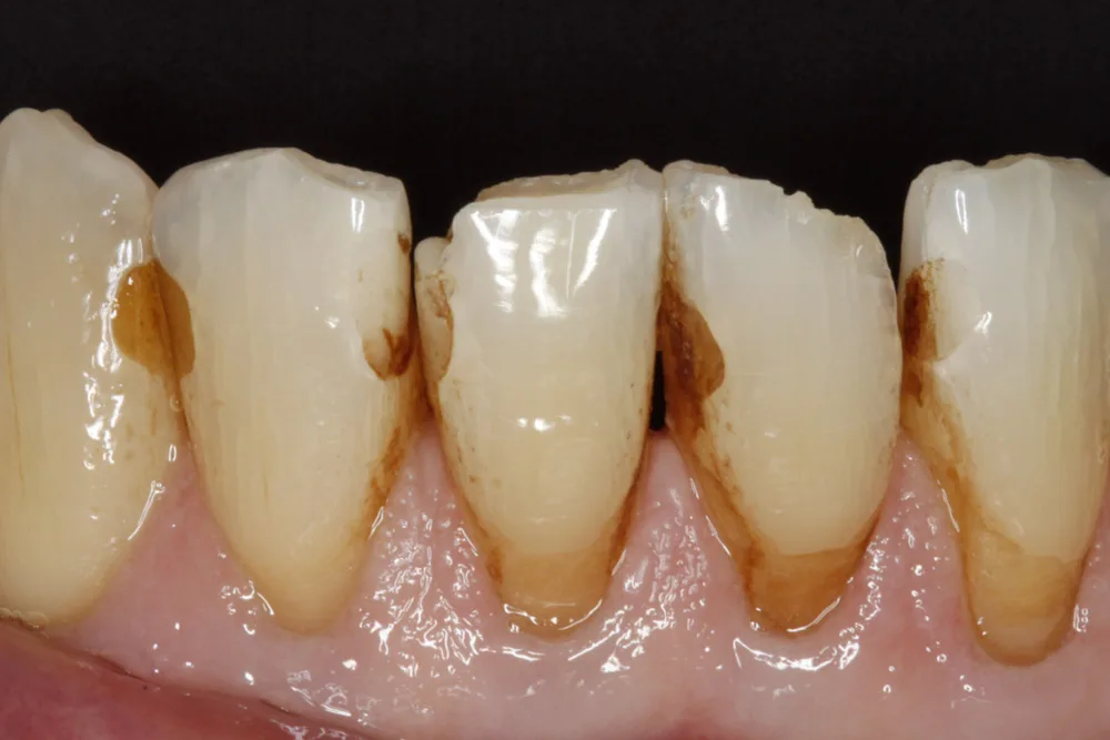 Combosite buildup before