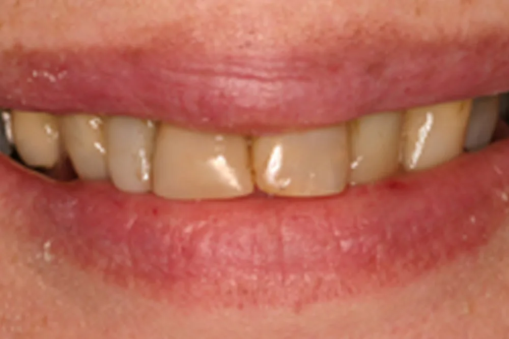 MG before