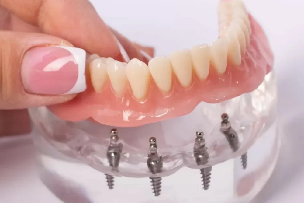 all on 4 dental implant system