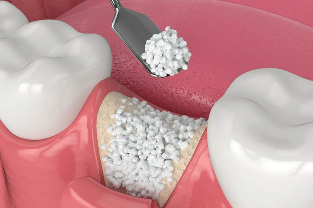 bone grafting and sinus img