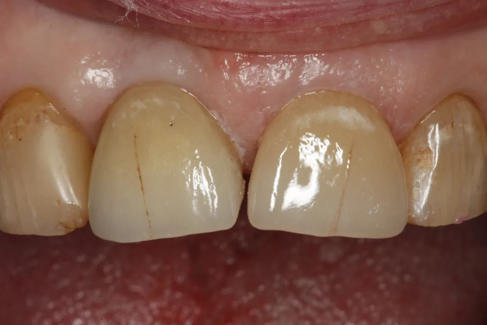 implant dbell after
