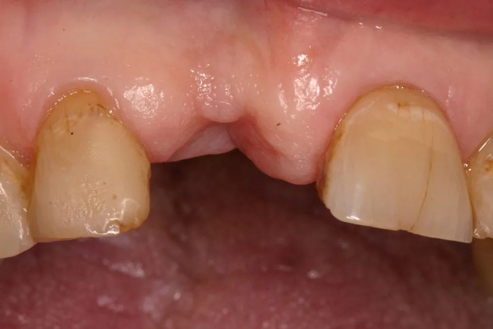 implant dbell before