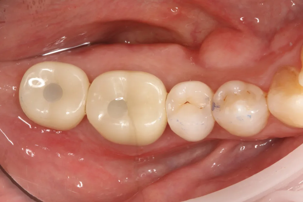 implant g after