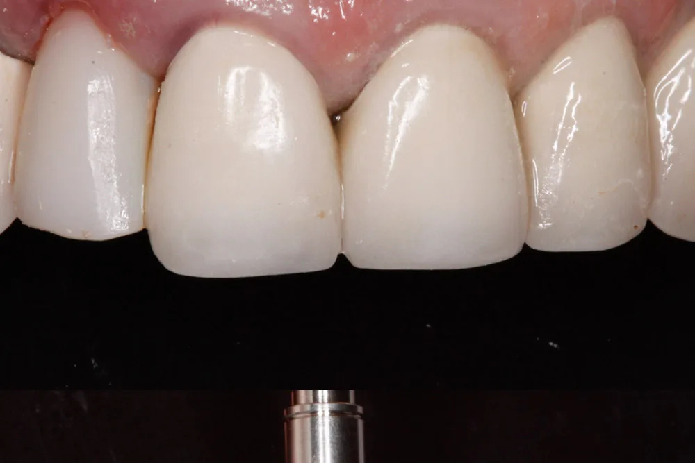 implant immediate after
