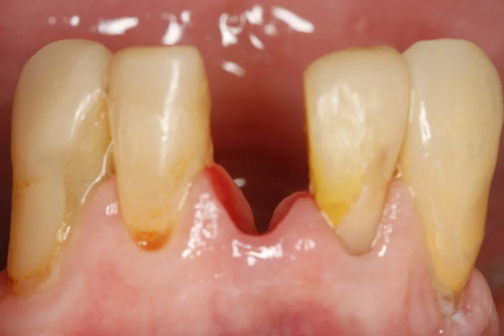 implant kc before