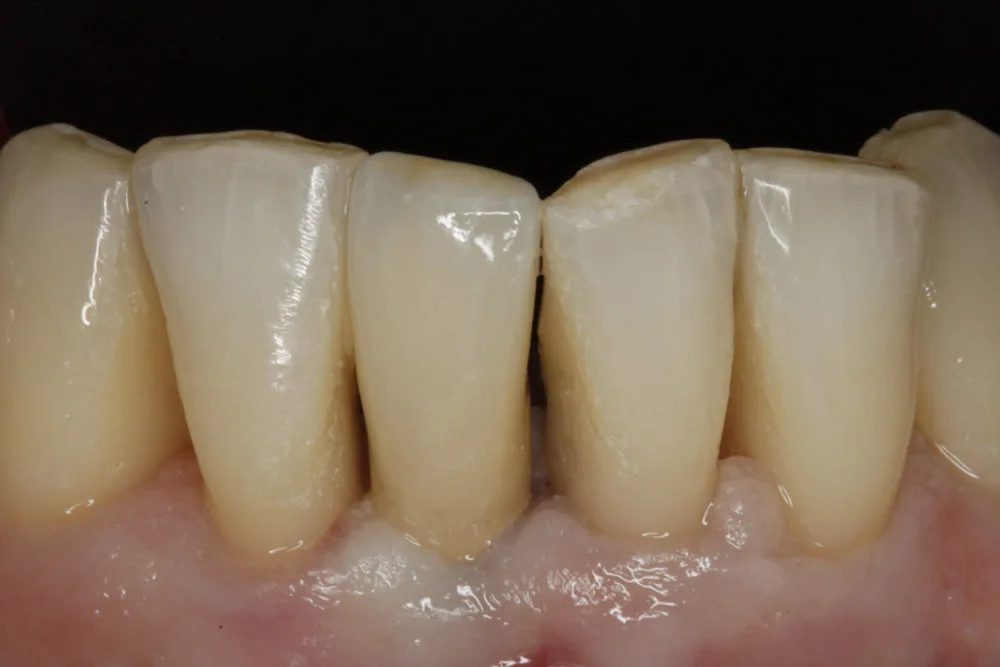 implant kr after