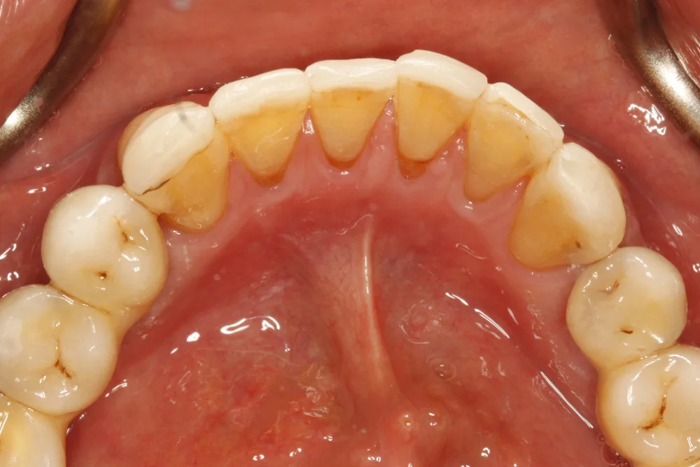 implant tll lower after