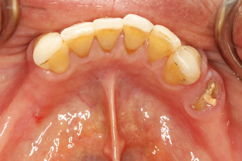 implant tll lower before