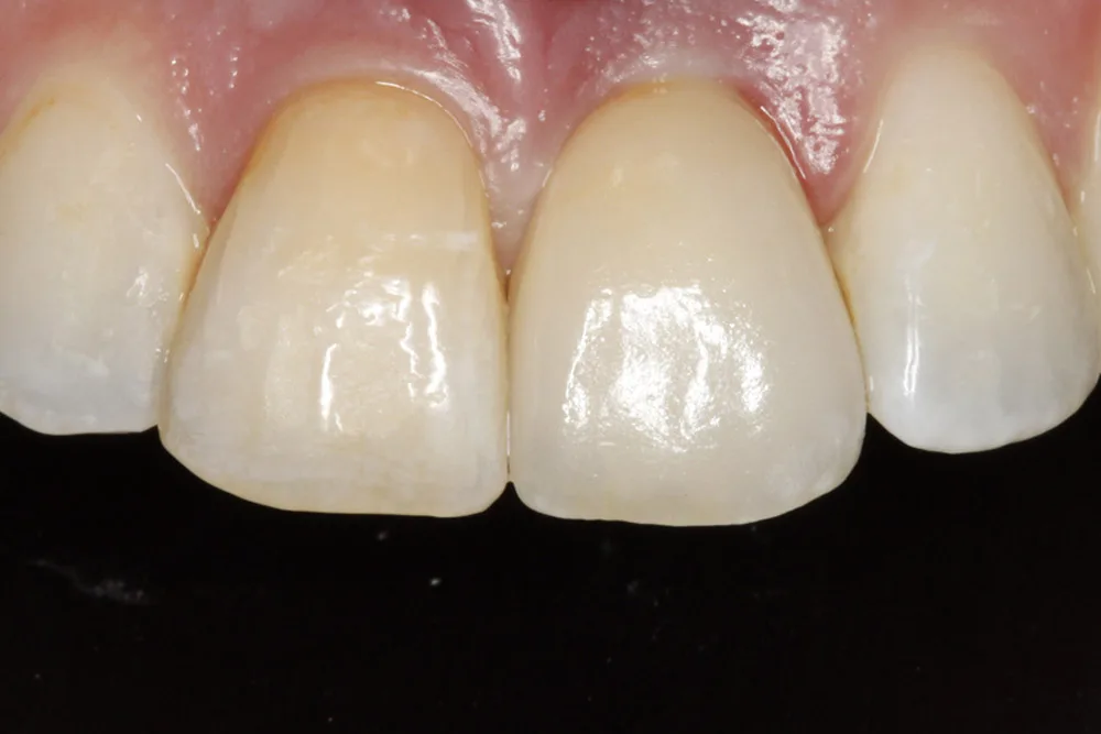 implant tp after