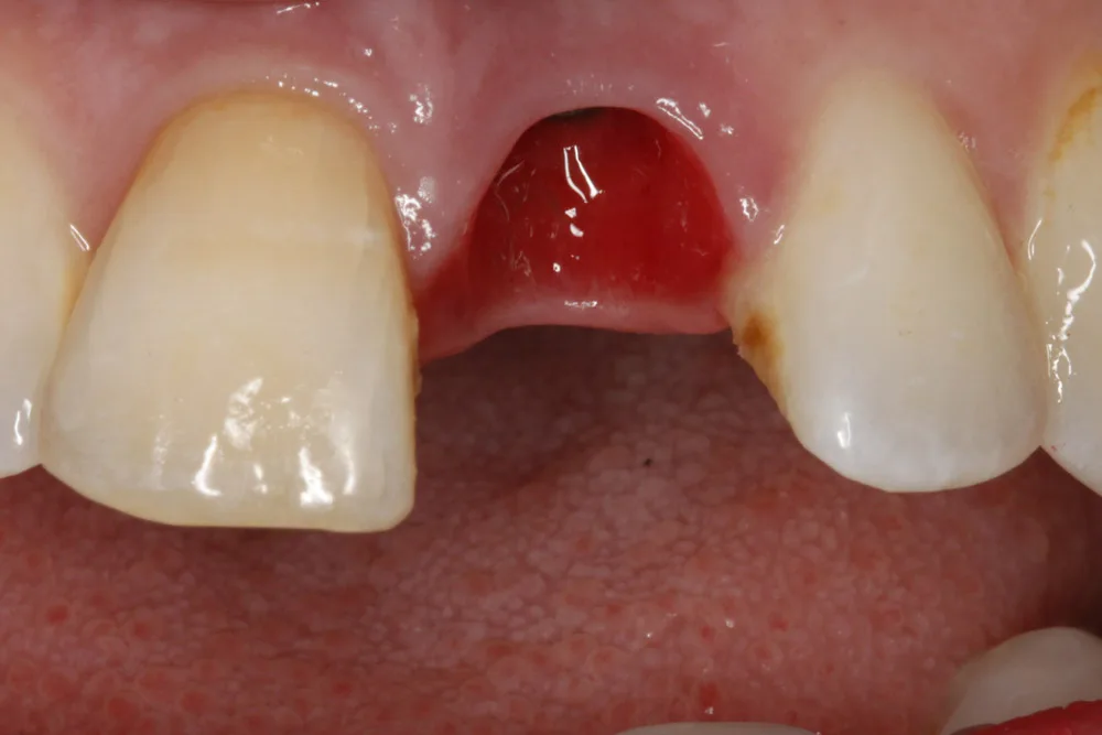 implant tp before