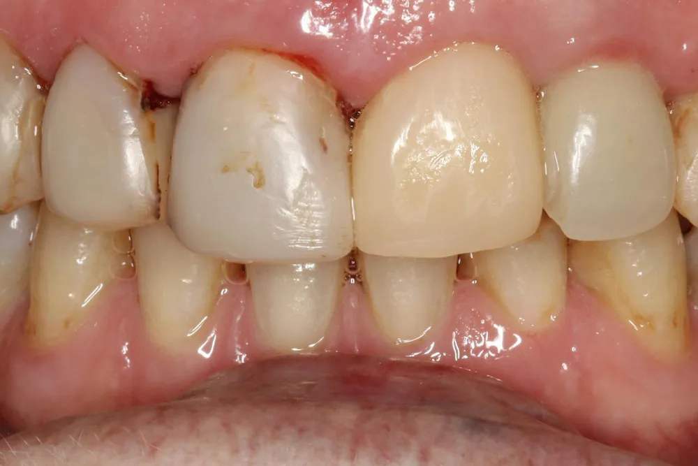 implant vh after