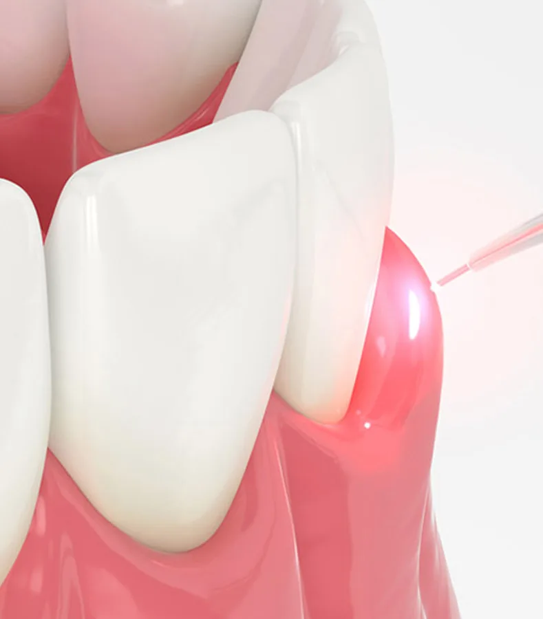 laser dentistry img3
