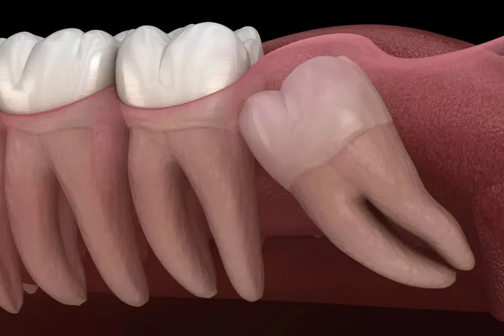 wisdom teeth extraction img