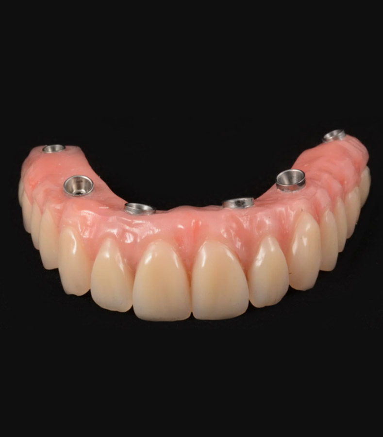 all on 4 dental implant img 4