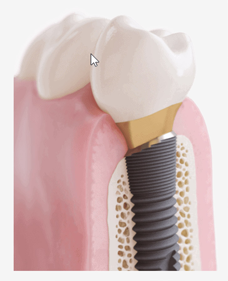 implant image