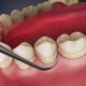 What Is a Cavity and How Does It Develop? How to Remove Calculus from Teeth