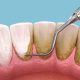 How to Remove Plaque from Teeth