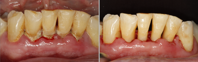gum disease before ad after