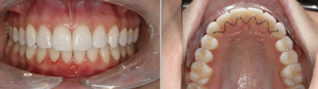 final lingual retainers final lingual retainers