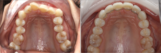 invisalign before after invisalign before after